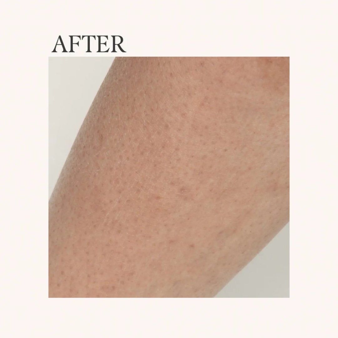 After laser hair removal comparison showing smoother skin