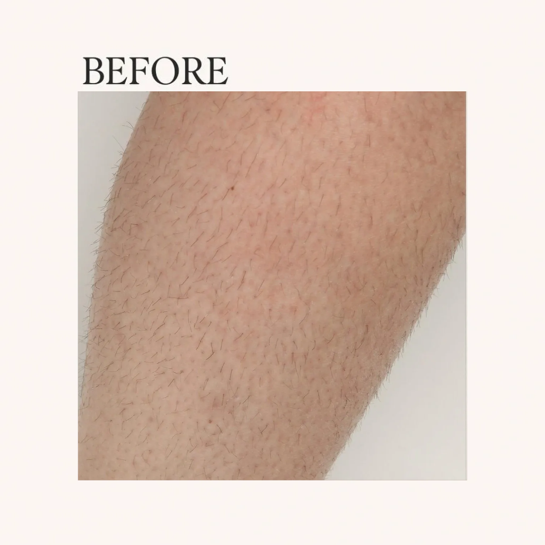 Before laser hair removal comparison on a treatment area